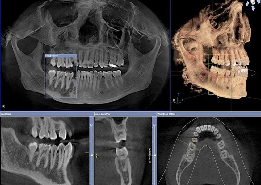 Tomografia Cone Beam