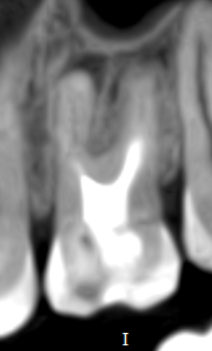 Corte tomográfico odontológico