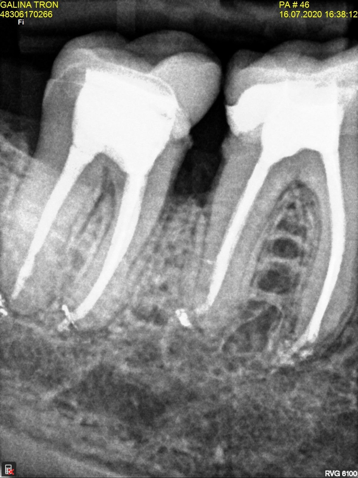 Radiografia periapical